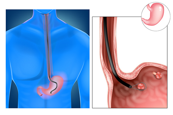 Esophagogastroduodenoscopy (EGD)