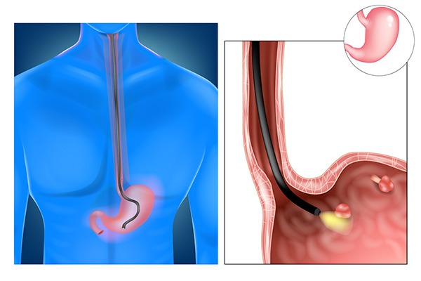 Endoscopic Ultrasound (EUS)